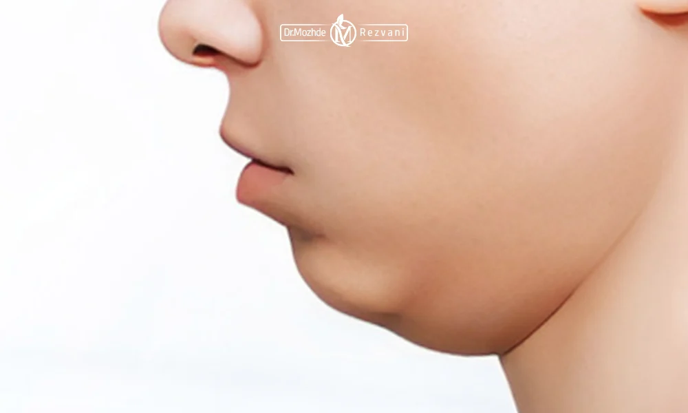 لیپوساکشن غبغب