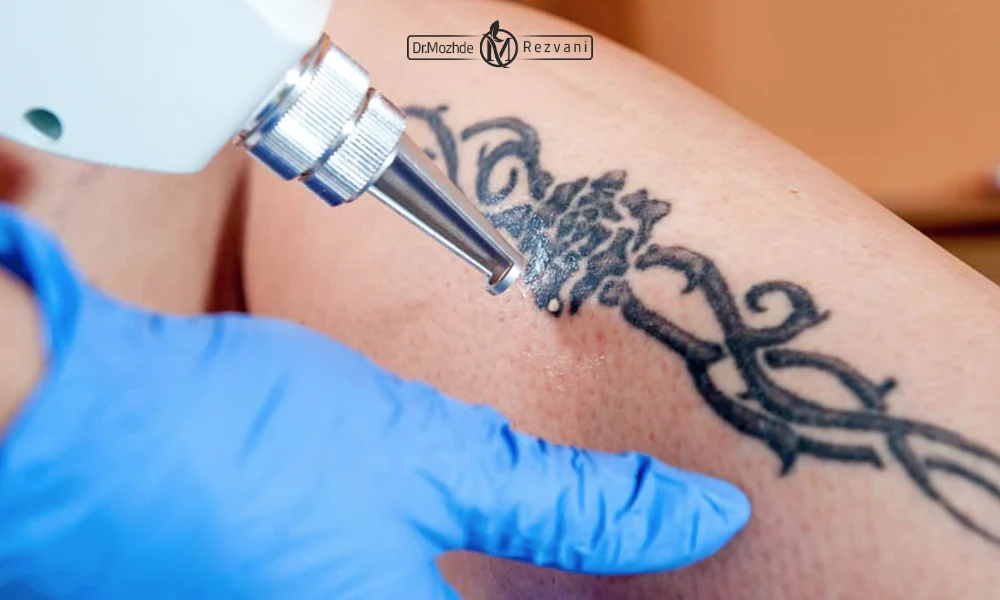 لیزر کیوسوئیچ بهترین درمان تتو