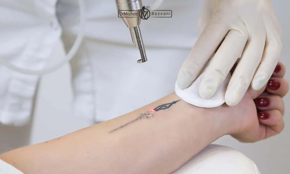 درمان تتو با لیزر کیو سوییچ