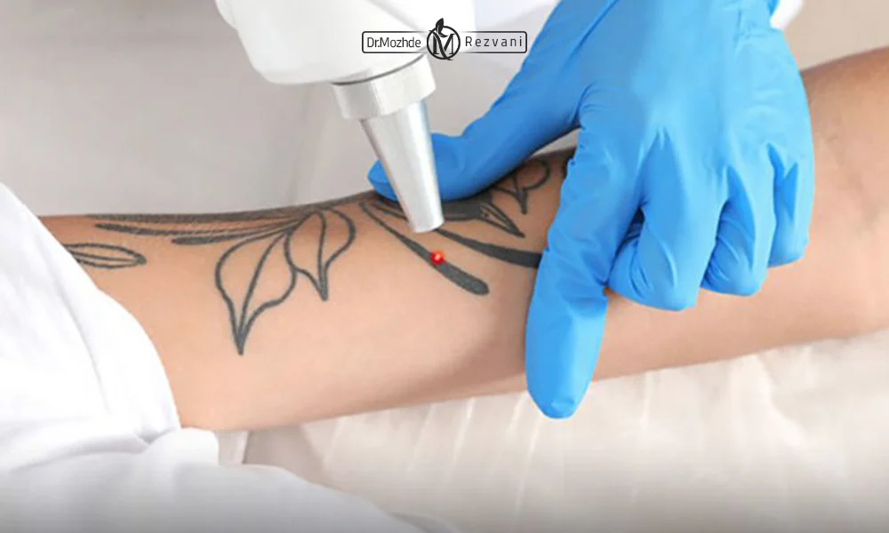 پاک کردن تتو با لیزر کیوسوییچ