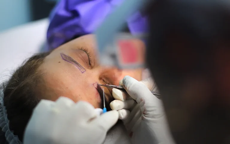photo of eyebrow transplantation surgery