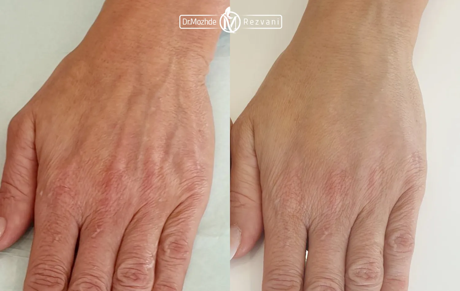 عکس قبل و بعد تزریق ژل دست