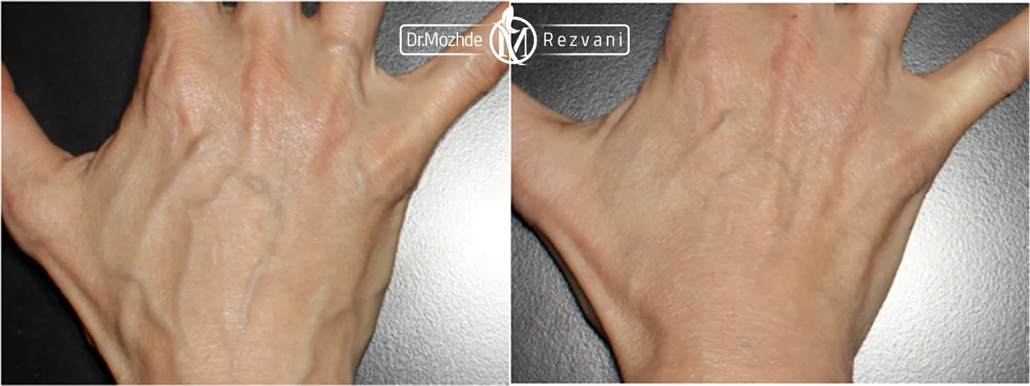 عکس قبل و بعد ژل دست - تزریق فیلر دست