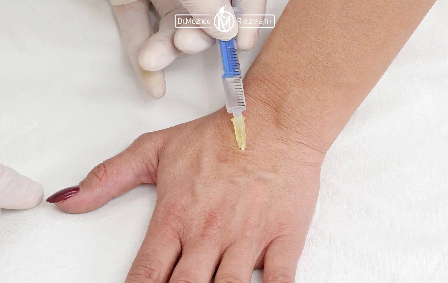 عکس تزریق ژل با سرنگ به پشت دست - تزریق فیلر دست