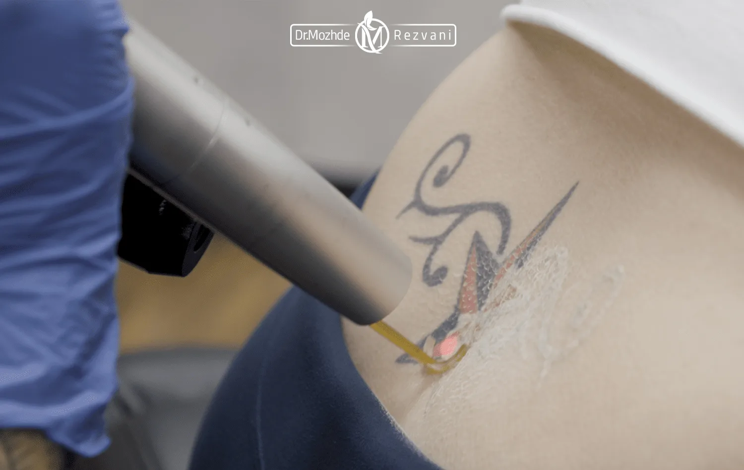 پاک کردن تتو روی کمر مراجعه کننده با لیزر کیوسوئیچ
