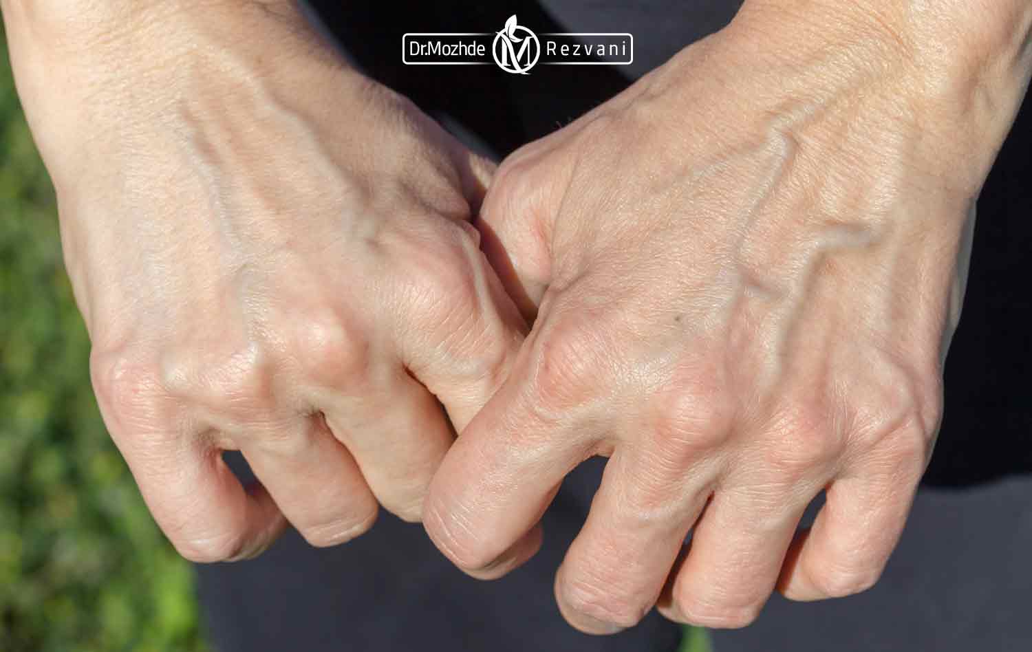 تصویری از دستان شخص مبتلا به واریس دست