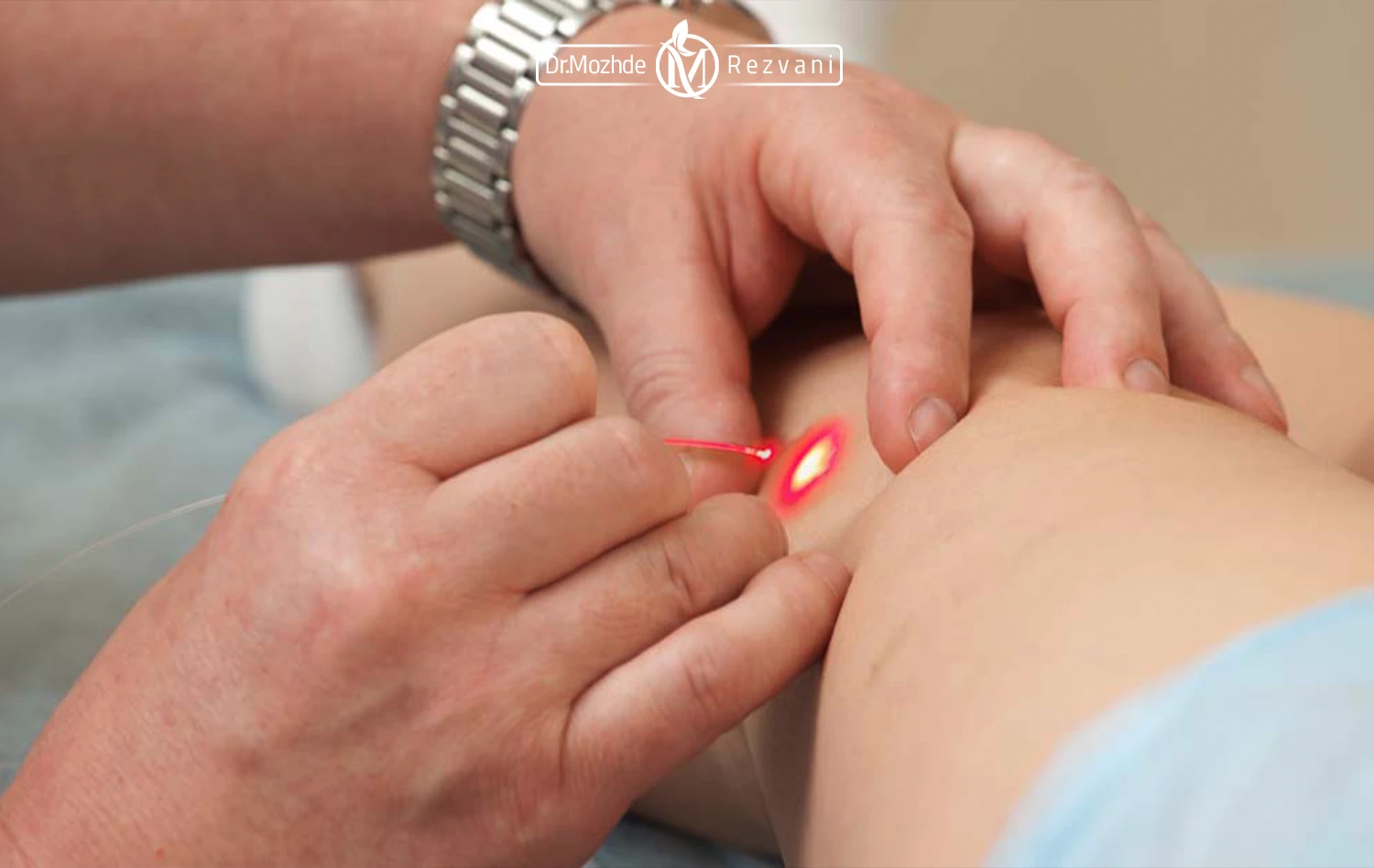 درمان واریس با لیزر | درمان ورید واریس پای یک آقای بیمار