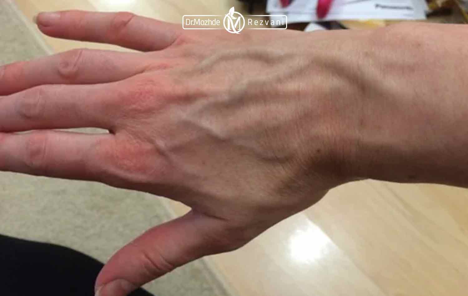 تصویری از رگ های واریسی دست فرد مبتلا