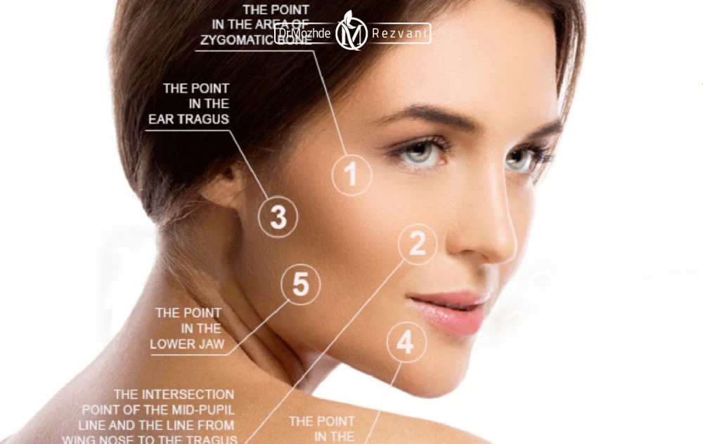 نفاط تزریق پروفایلو به صورت یک خانوم زیبا جو