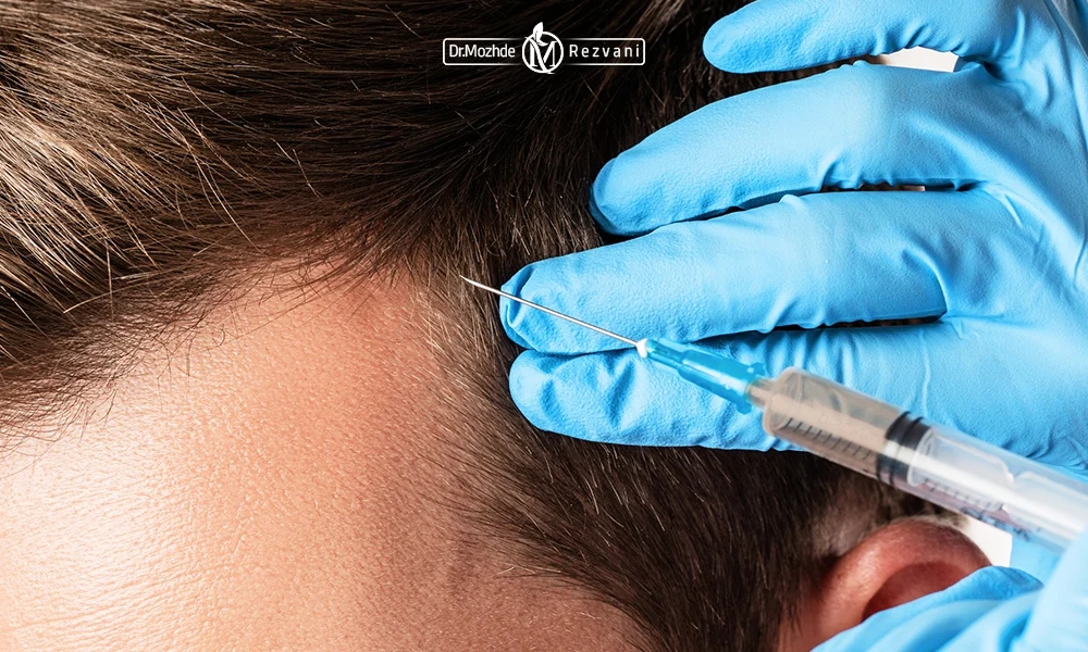 تزریق پی آر پی مو سر یک آقا