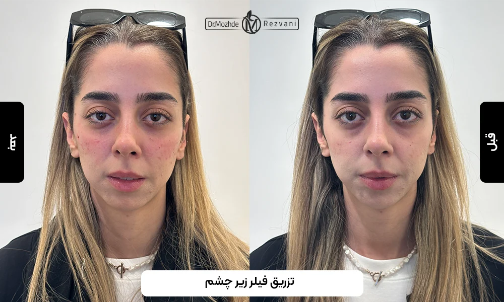 نمونه کار تزریق فیلر 