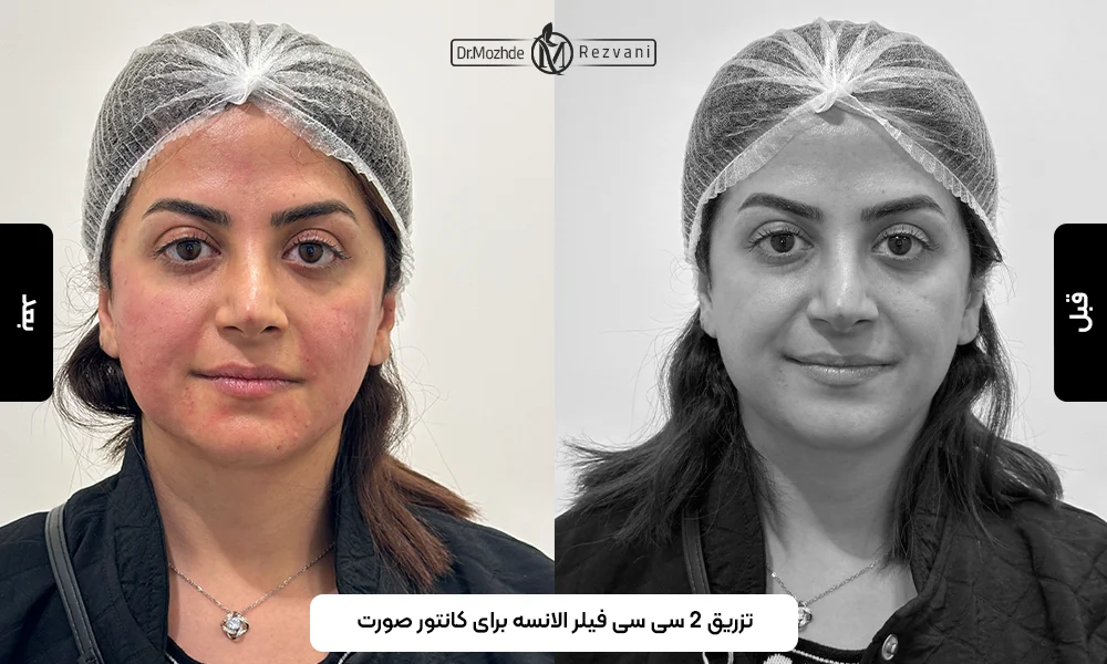 نمونه کار تزریق فیلر 