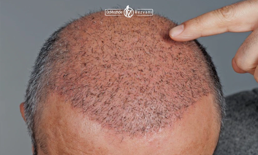 مردی که بر روی سر خود مو کاشته است.