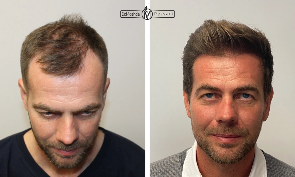 نمونه کاری قبل و بعد کاشت مو