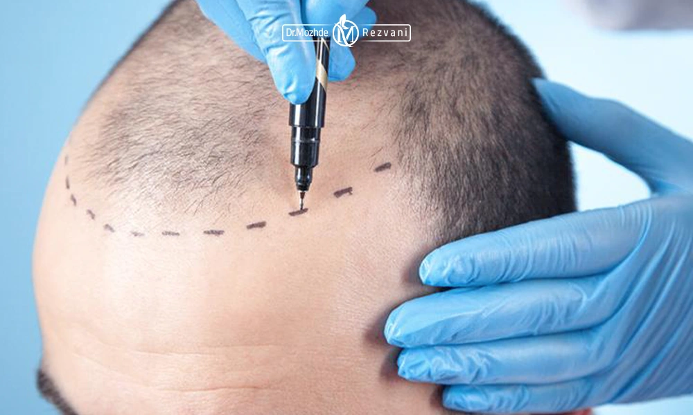 ترسیم خط رویش قبل از کاشت مو