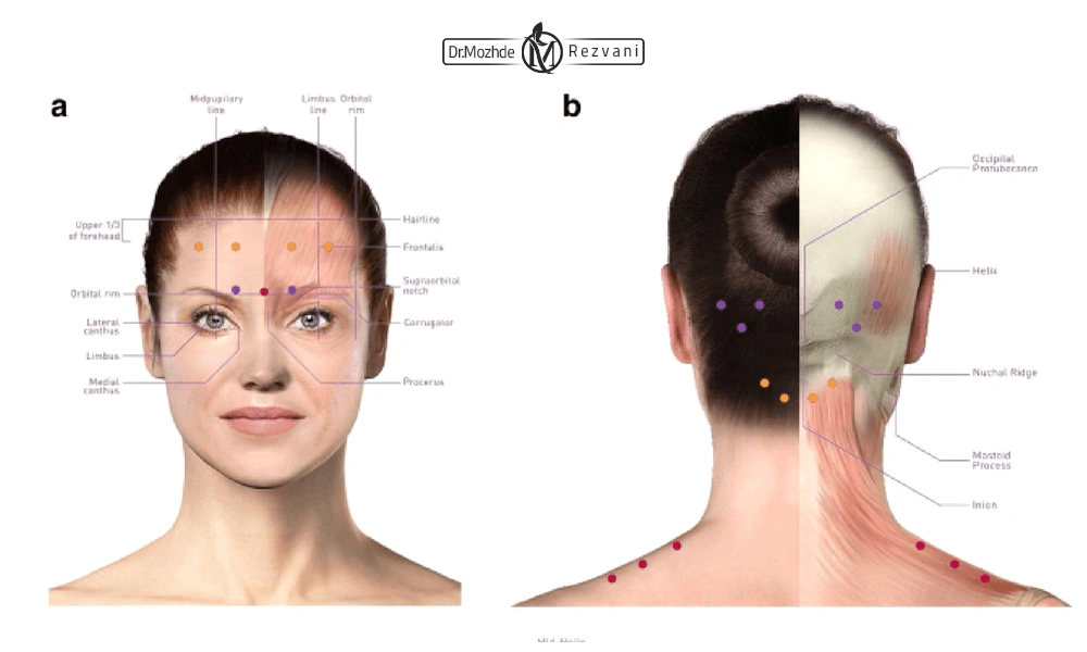 عکس نواحی تزریق بوتاکس برای رفع سردرد میگرنی