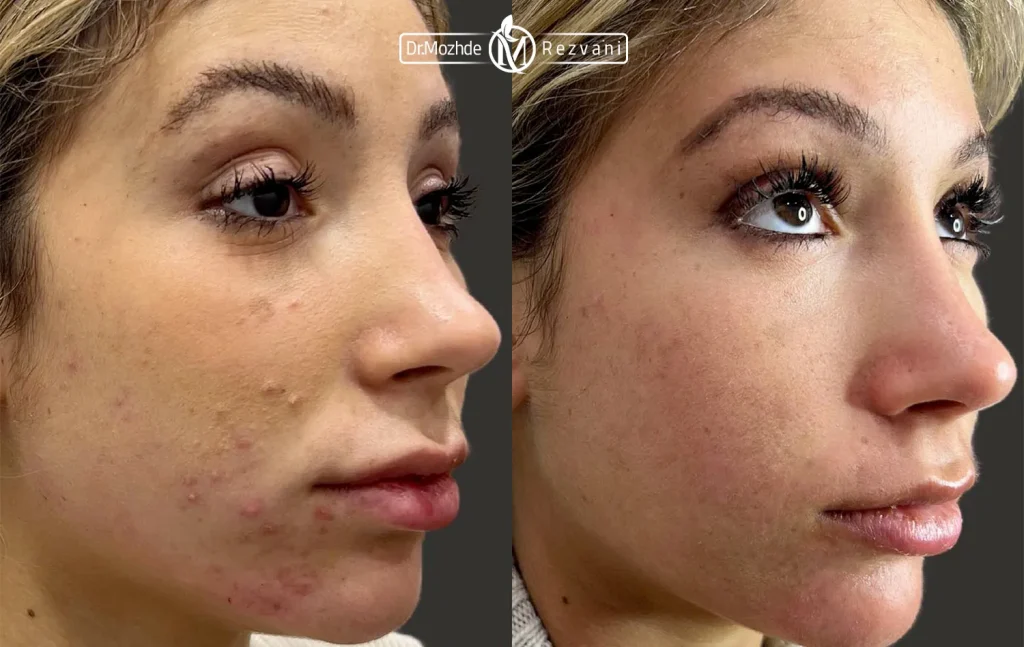 تصویر قبل و بعد درمان جوش صورت با کربن تراپی