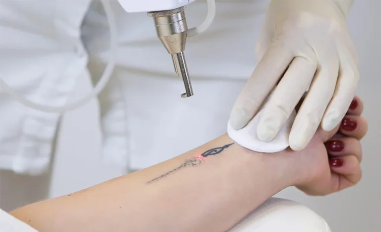 پاک کردن تتو از روی مچ دست زن با دستگاه لیزر کیوسوئیچ