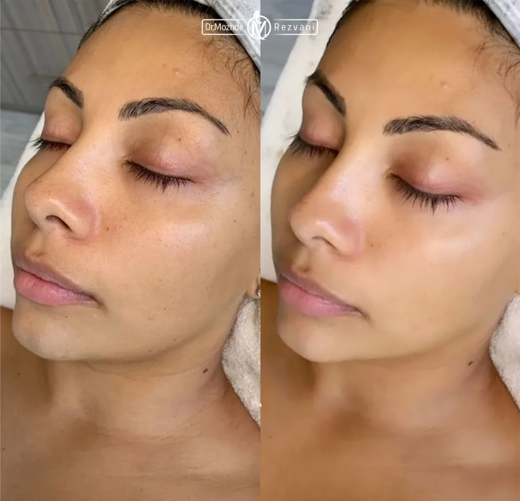 عکس قبل و بعد کربن تراپی و درمان لک صورت