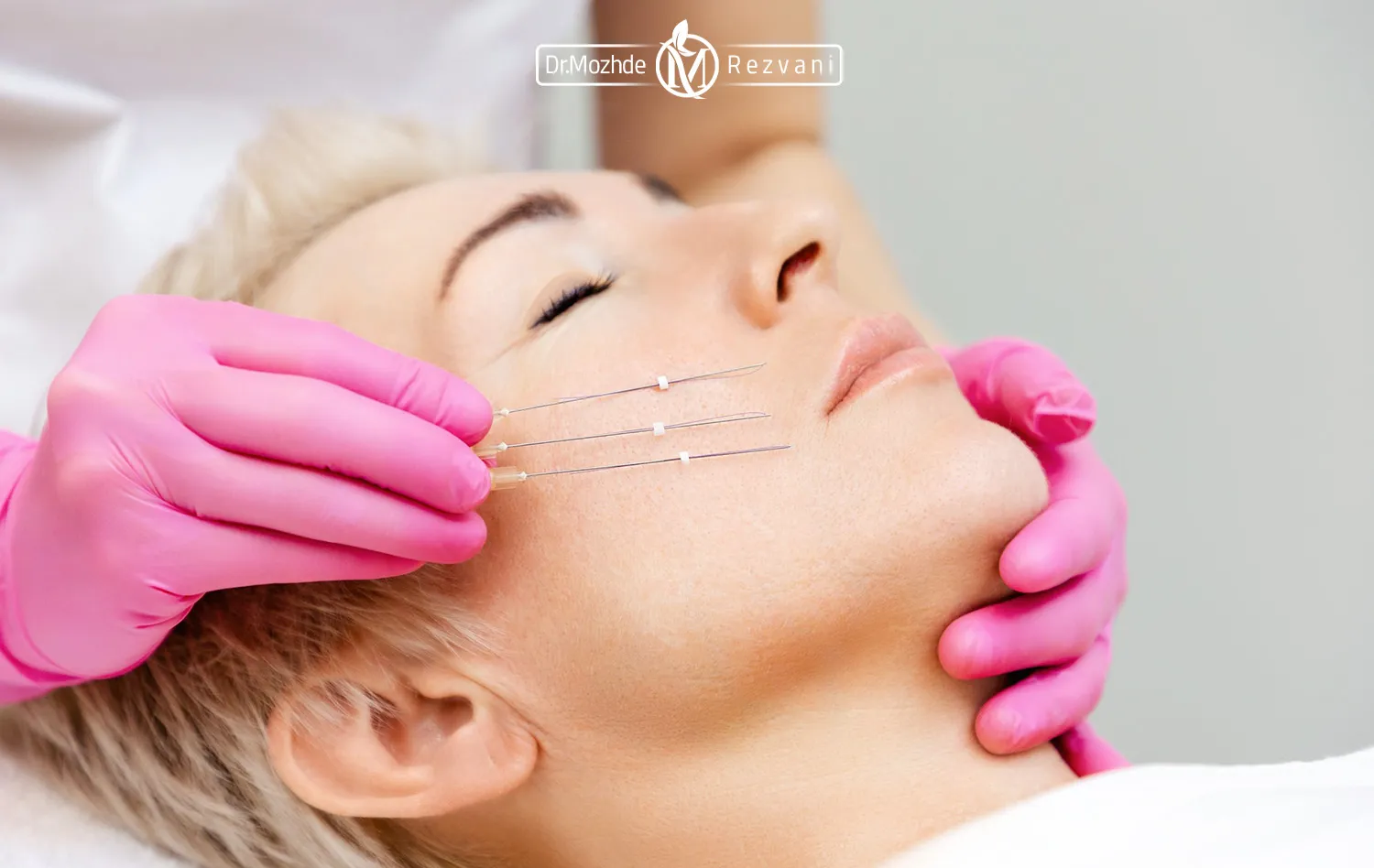 تصویر مربوط به یک خانم است و دستای یک دکتر که دستکش صورتی پوشیده و در حال لیفت صورت با نخ است