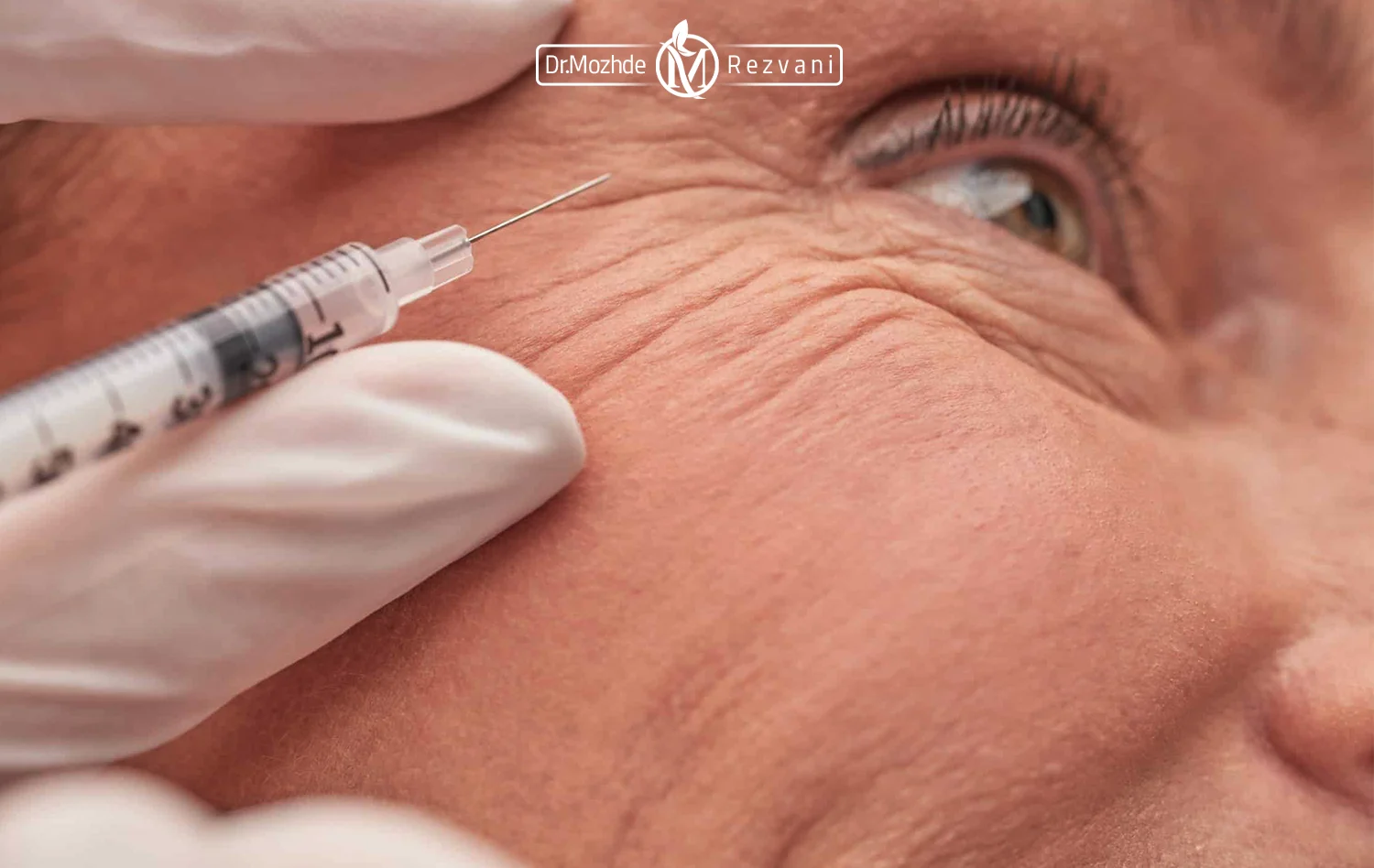تزریق فیلر به زیر چشم های یک خانم برای درمان چین و چروک پا کلاغی