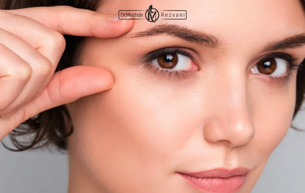 کشش گوشه چشم با بوتاکس برای یک زیبا جو