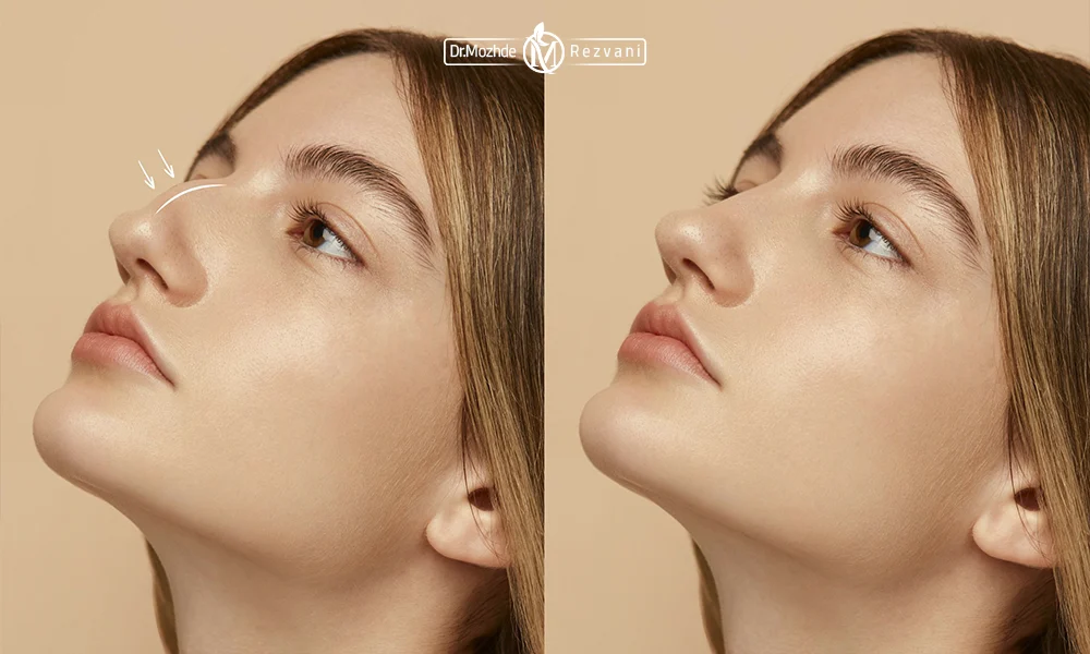 انواع روش لیفت بینی