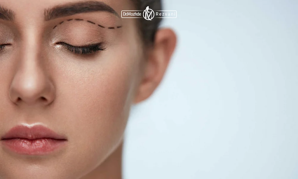 آشنایی با انواع روش لیفت چشم