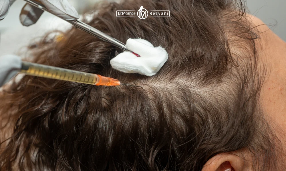 تزریق پی آر پی مو برای یک آقا