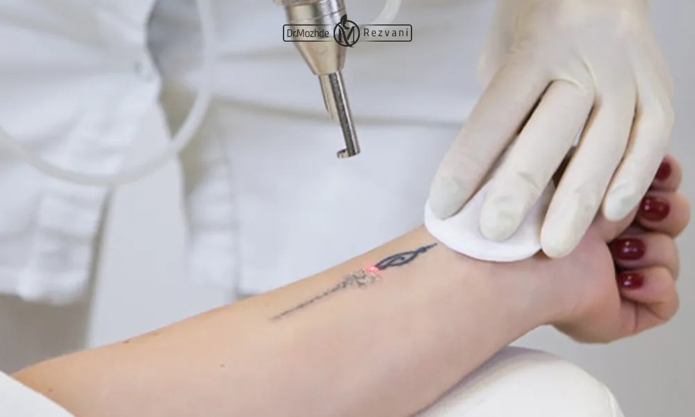 نحوه پاک شدن تاتو با لیزر کیو سوئیچ