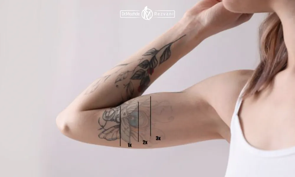 مراحل لیزر کیوسوئیچ برای از بین بردن تاتو