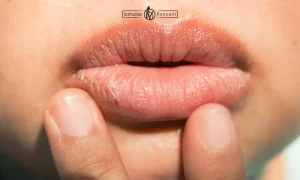 خانمی که دچار خشکی لب بعد از تزریق ژل لب شده است.