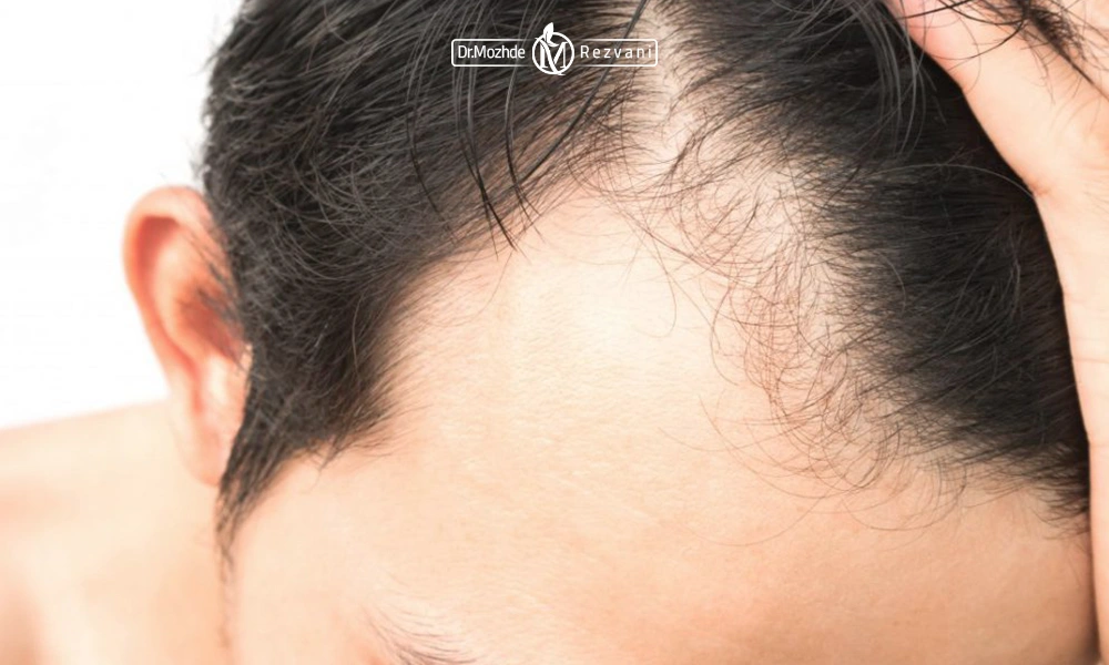 بهترین فصل برای کاشت مو