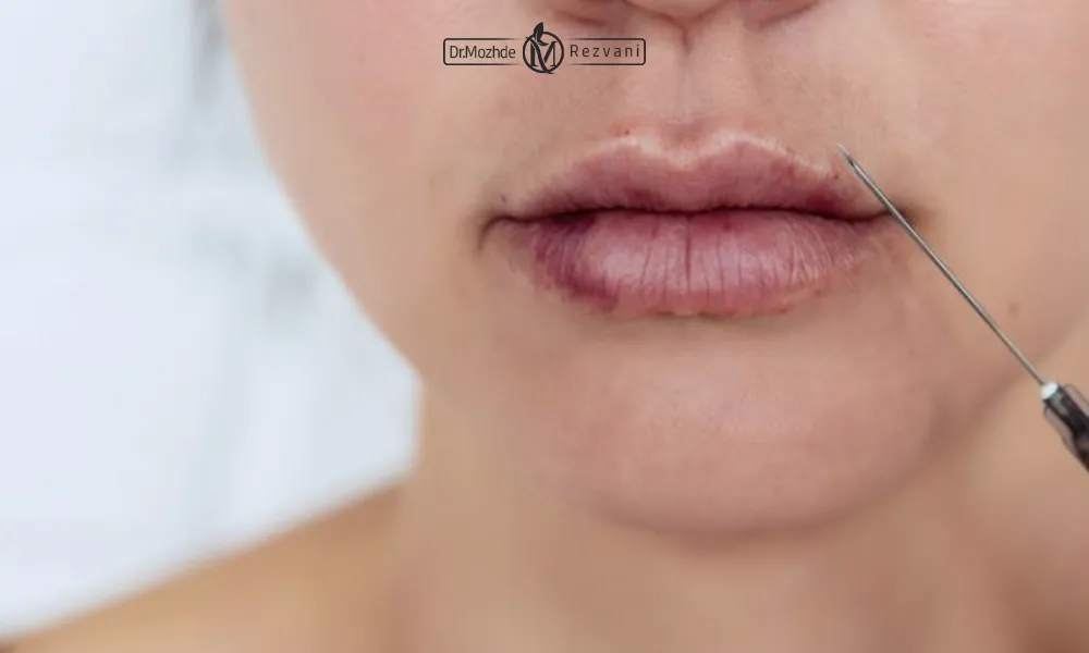 عکس کبودی لب بعد از تزریق ژل | خانمی که دچار کبودی بعد از تزریق ژل لب شده است