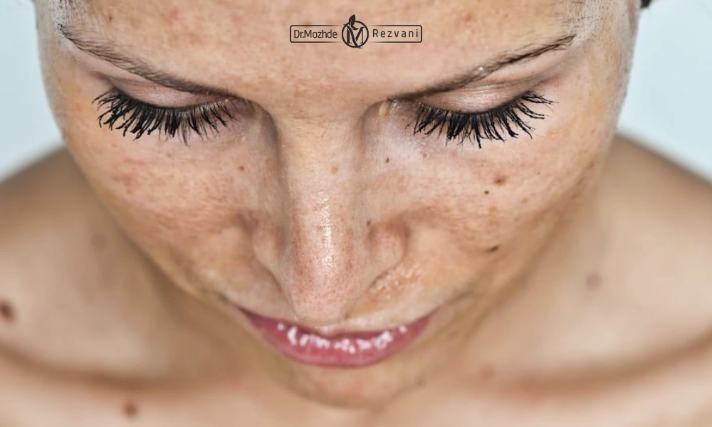 اثرات آفتاب سوختگی روی صورتیک خانم | درمان صورت نامتقارن