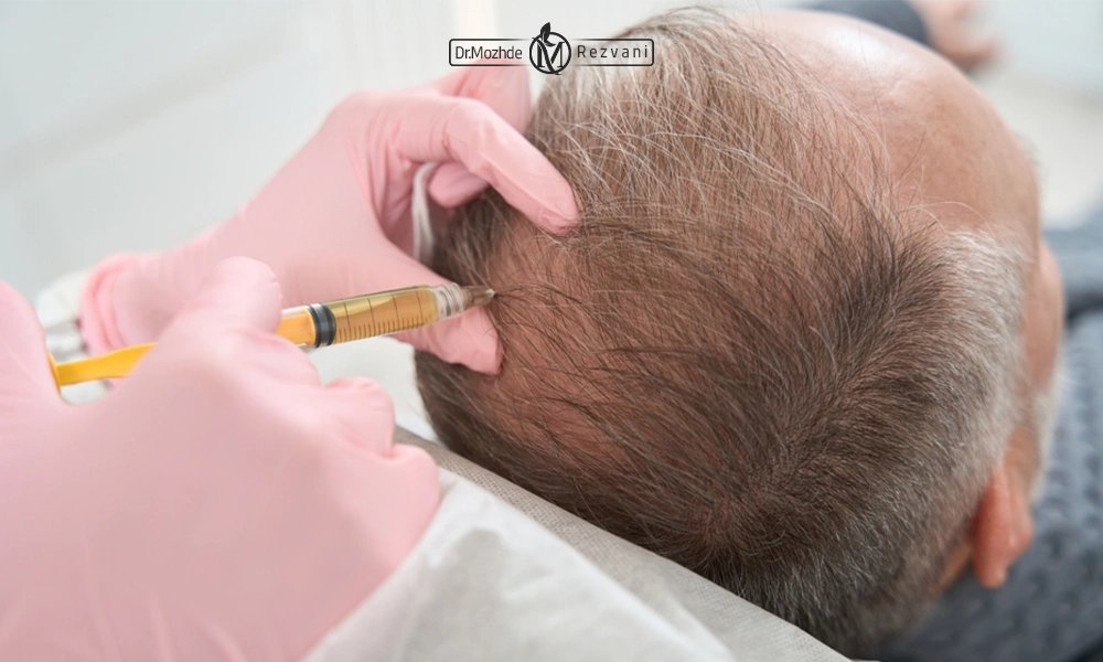 تزریق پی آر پی مو سر یک آقا | پی آر پی مو بهتر است یا مزوتراپی ؟