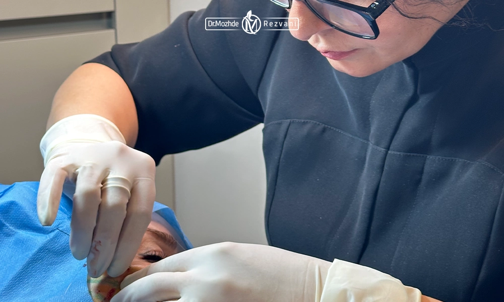 خانم دکتر رضوانی در حال انجام لیفت با نخ سیلوئت