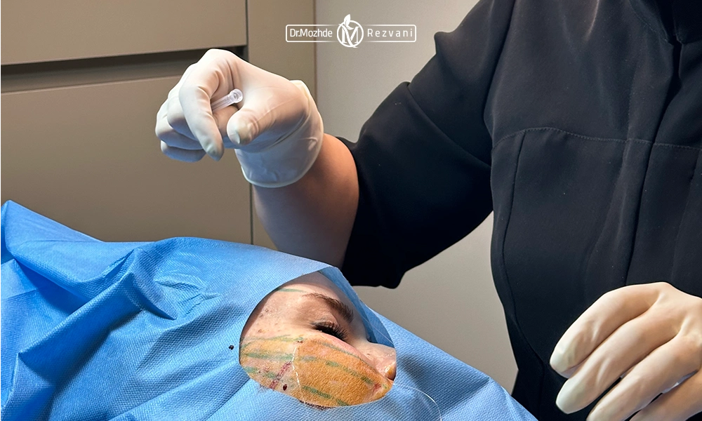 خانم دکتر رضوانی در حال انجام لیفت با نخ سیلوئت