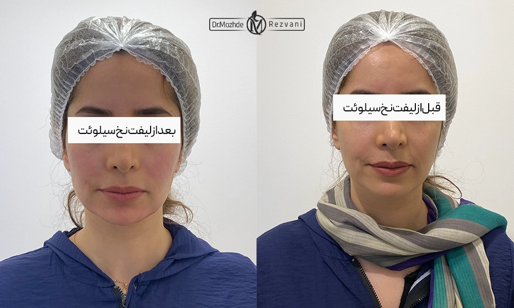 لیفت با نخ سیلوئت