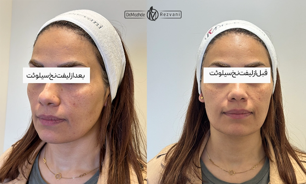 لیفت با نخ سیلوئت