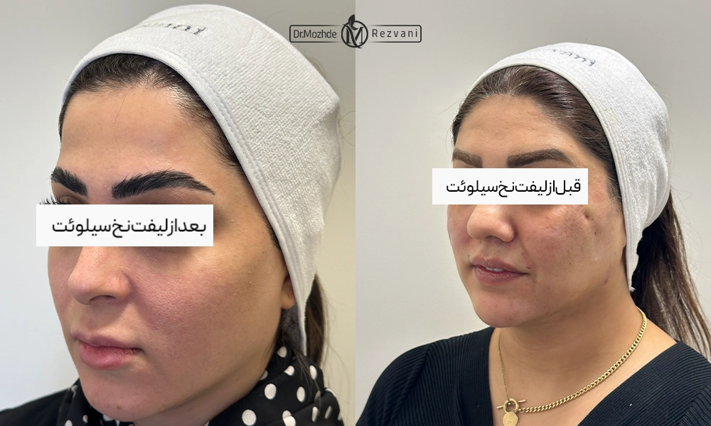 لیفت با نخ سیلوئت