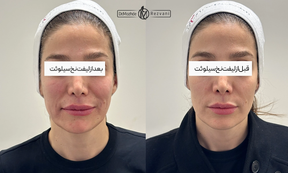 نمونه کار لیفت با نخ سیلوئت