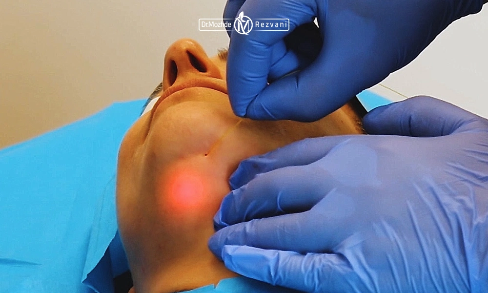 اندولیفت غبغب توسط پزشک زیبایی