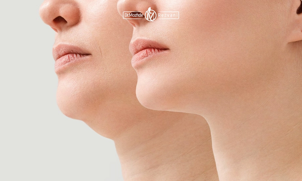 نتیجه اندولیفت غبغب