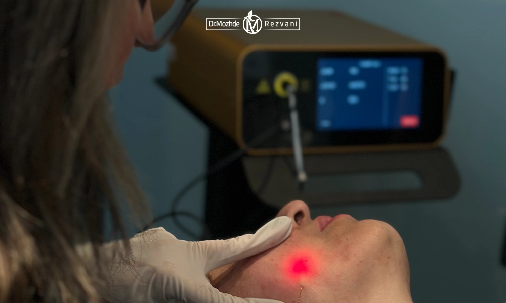 انجام اندولیفت صورت توسط دکتر رضوانی