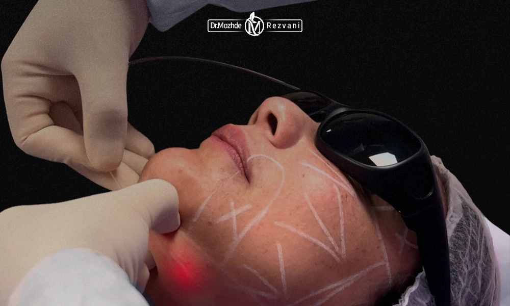 انجام اندولیفت غبغب