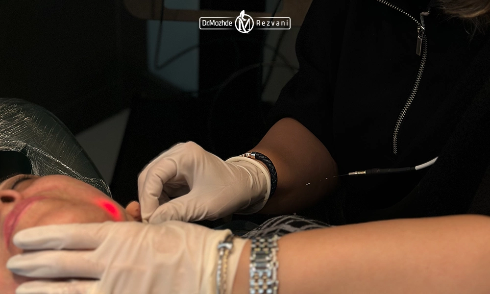 انجام اندولیفت توسط دکتر رضوانی