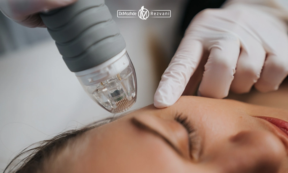 میکرونیدلینگ شقیقه | فواید میکرونیدلینگ صورت
