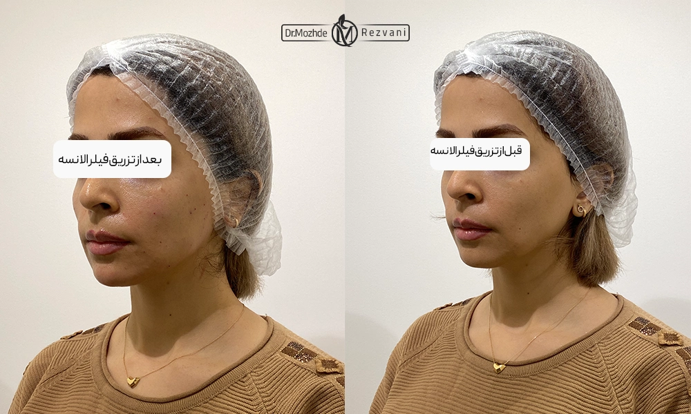 نمونه کار تزریق فیلر الانسه