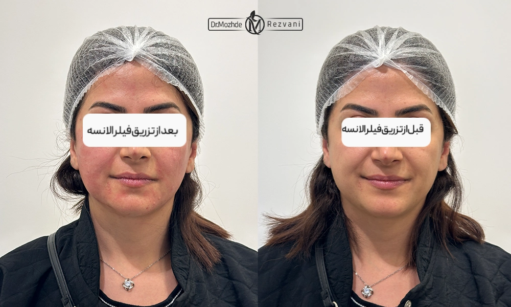 نمونه کار تزریق فیلر الانسه